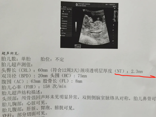 nt0.16cm、头臀长6.2揭秘胎儿性别，猜一猜男孩还是女孩